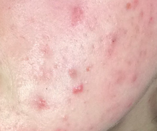 wat is acne vulgaris